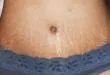 How-to-get-rid-of-stretch-marks-fast